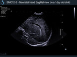 SMC12-3- Neonatal head Sagittal-view-on-a-1d-old-child Aixplorer SuperSonic Imagine