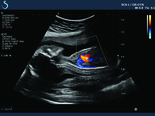Fetal Heart and sagital aorta
