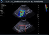 Liver nodule 2 months , Pediatrics,  ShearWave Elastography