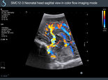 Neonatal head sagittal view in color flow imaging mode SuperSonic Imagine Aixplorer