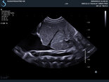SMC12-3 Abdominal imaging on 1m old child