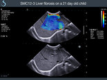 SMC12-3 Liver fibrosis on a 21d old child - Aixplorer SuperSonic Imagine